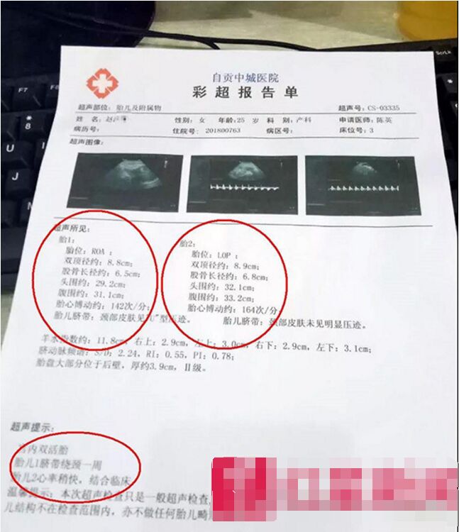 孕妇产检多次B超均为双胞胎，剖腹产后只有一胎：孩子去哪了？