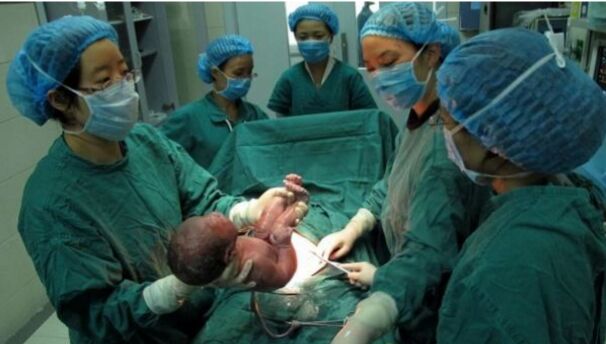 孕妇产检多次B超均为双胞胎，剖腹产后只有一胎：孩子去哪了？