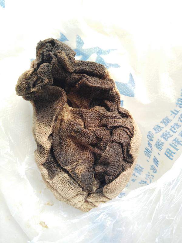 女生无麻药流产手术疼痛难忍,女性流产后腹痛里急后重