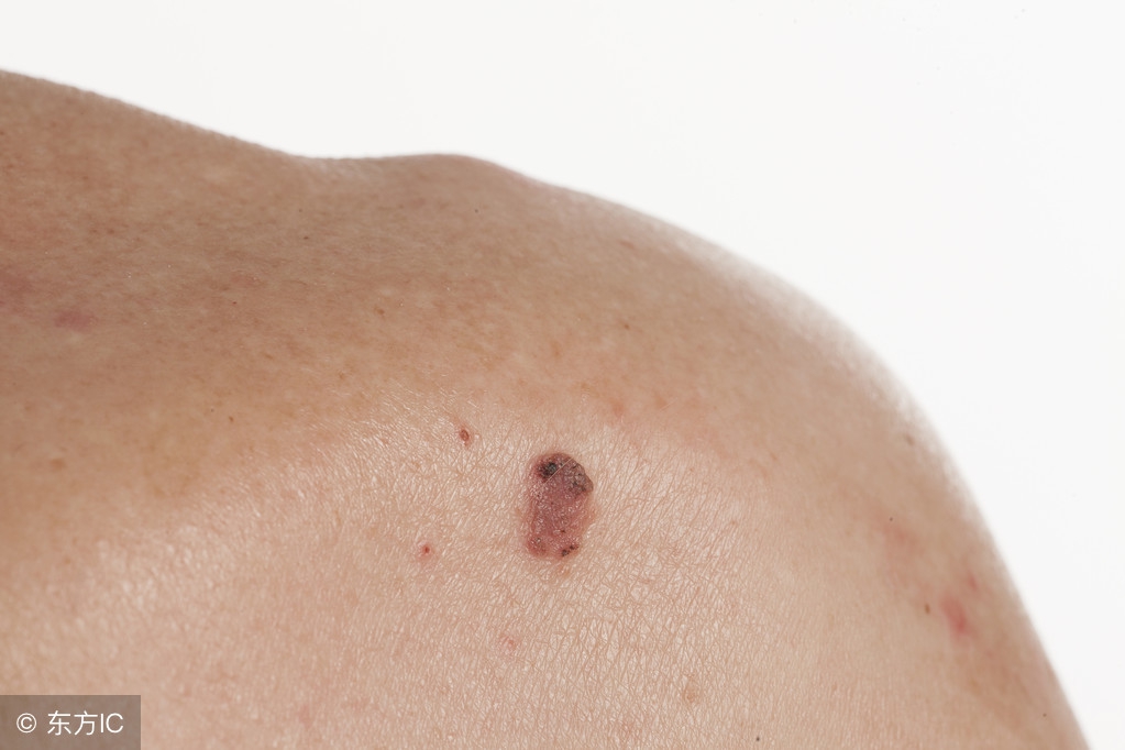 哪些皮肤病是皮肤癌的前兆呢,哪些皮肤病是癌症的前兆