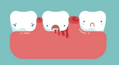 没刷牙的时候牙龈出血是什么原因,早上起来刷牙牙龈出血恶心干呕