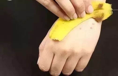 蚊子咬完红肿硬很大怎么样能止痒,被蚊子咬到眼睛最快消肿止痒妙招