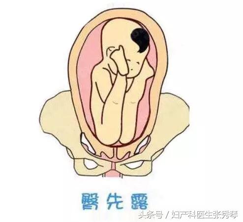 孕晚期时出现胎位不正要怎么应对,孕晚期胎位不正的常见原因