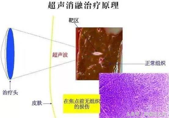 不开刀也能减瘤,海扶聚焦超声消融手术费用是多少