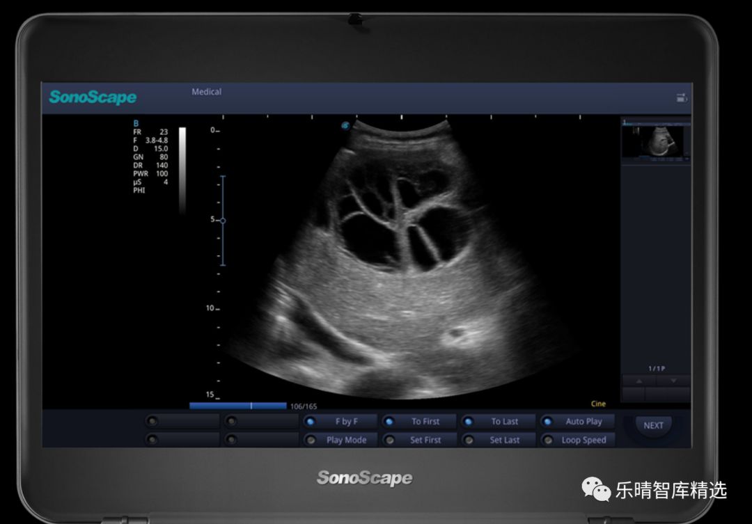 彩超发展到几代了,彩超技术发展史