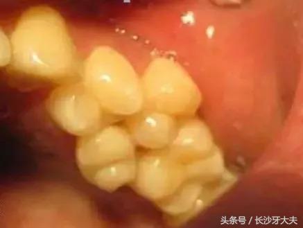 孩子门牙多生牙拔了之后牙缝很大,8岁男童多生牙门牙缝隙大