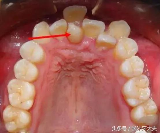 孩子门牙多生牙拔了之后牙缝很大,8岁男童多生牙门牙缝隙大