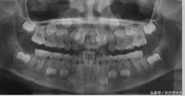 孩子门牙多生牙拔了之后牙缝很大,8岁男童多生牙门牙缝隙大