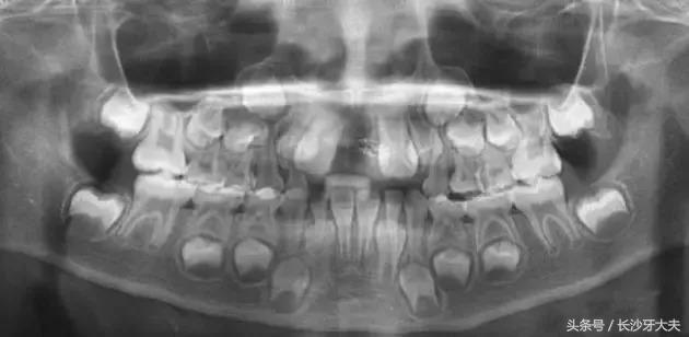孩子门牙多生牙拔了之后牙缝很大,8岁男童多生牙门牙缝隙大
