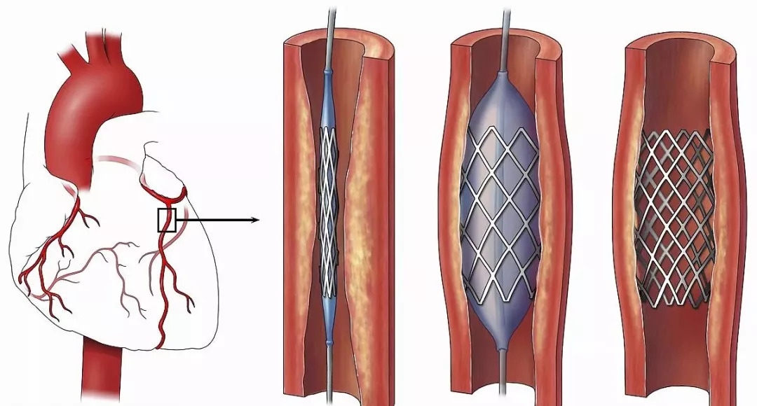 体内装有支架能运动吗,爱克塞尔支架可以做核磁共振吗