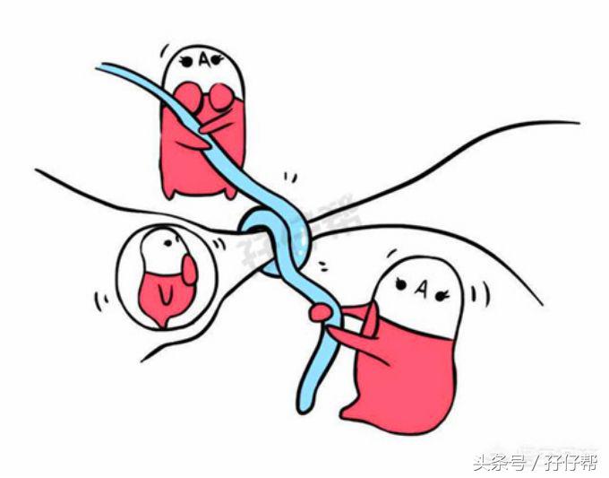 二胎剖腹产的真实经历,双胎妈妈怀孕的痛苦