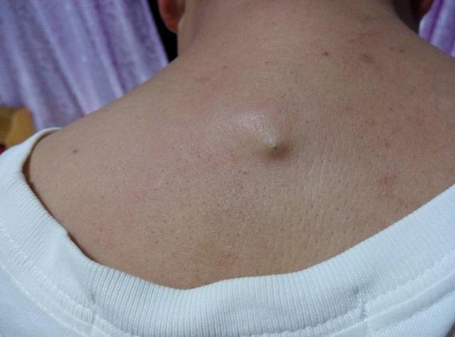 后背螨虫最好的特效药,后背螨虫最佳去除方法