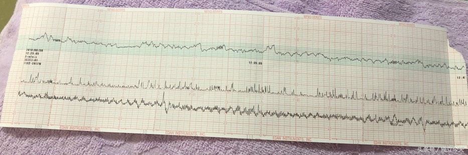 33周胎动减少测胎心监护说要吸氧,怀孕13周未见明显胎心搏动及胎动