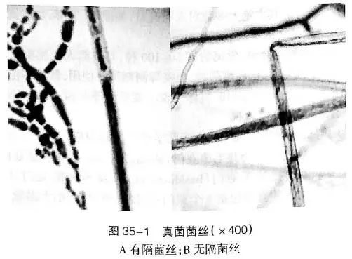 看懂痰涂片的真菌结果就这么简单！