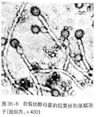 看懂痰涂片的真菌结果就这么简单!