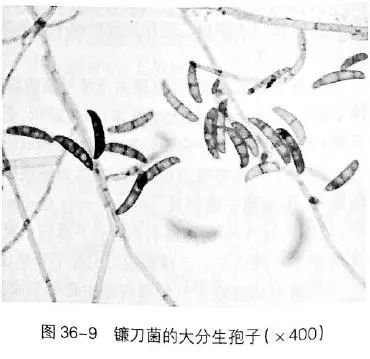 看懂痰涂片的真菌结果就这么简单!