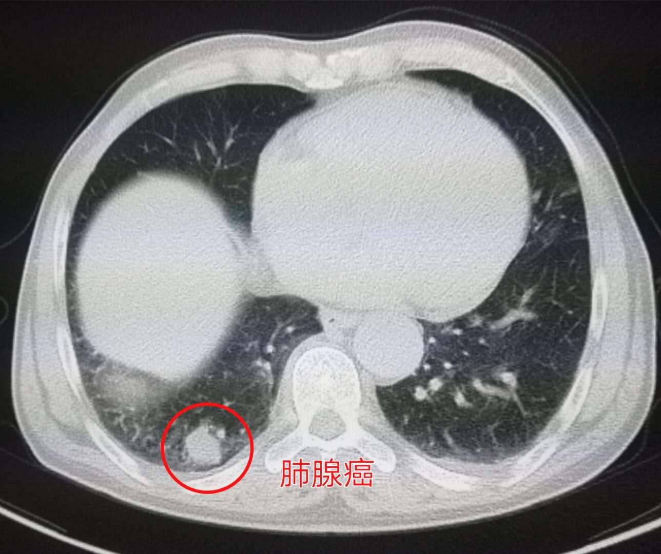 4种症状要查脑血管,这些症状一定要做脑血管造影