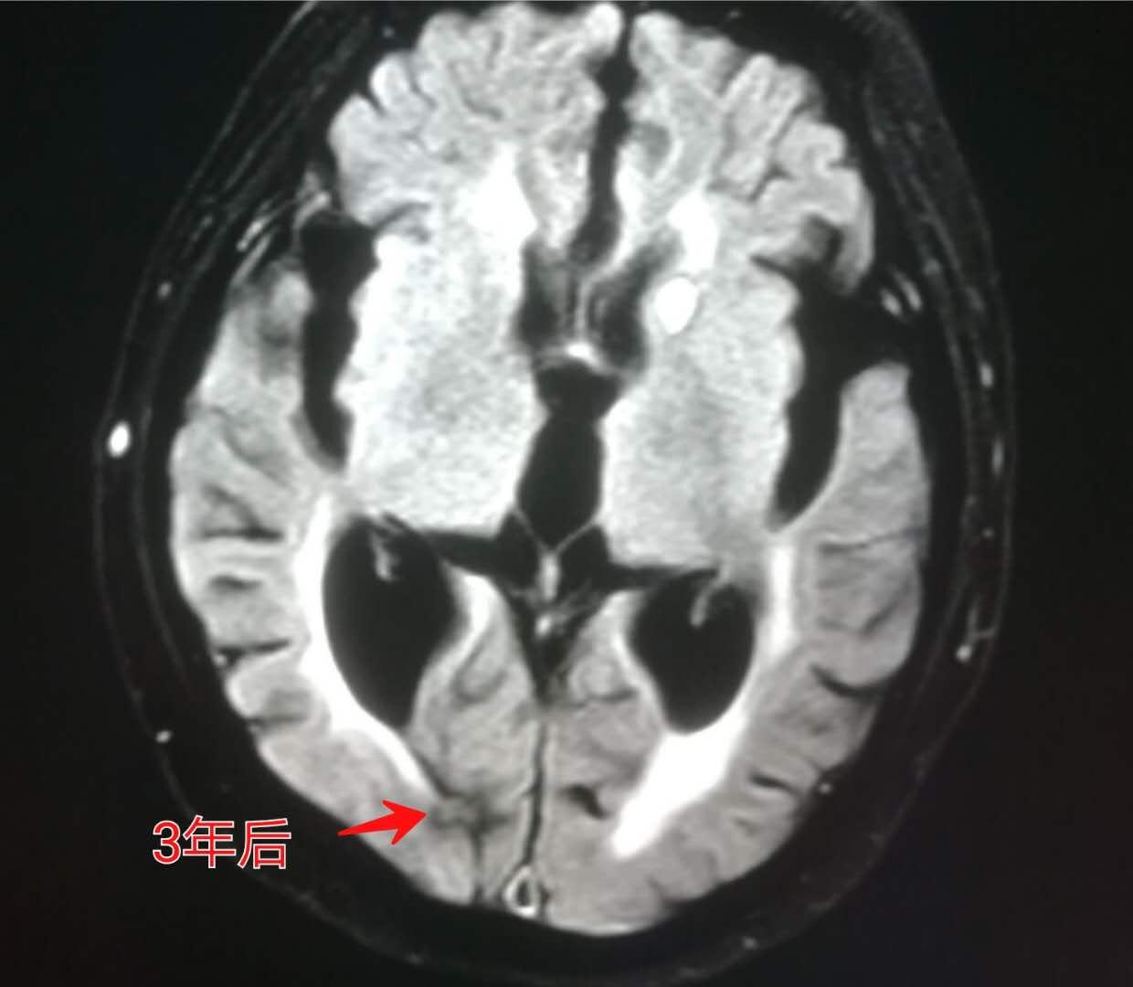 4种症状要查脑血管,这些症状一定要做脑血管造影