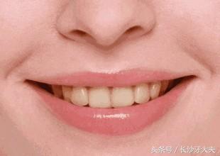 怎么让大黄牙快速变白,30天解决大黄牙