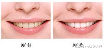 怎么让大黄牙快速变白,30天解决大黄牙