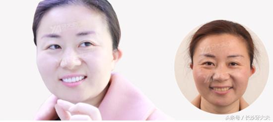 怎么让大黄牙快速变白,30天解决大黄牙