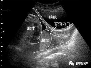 前置胎盘下怀的宝妈,前置胎盘的孕妈