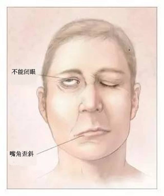 怎样才能做到歪嘴,小孩面瘫嘴歪的原因