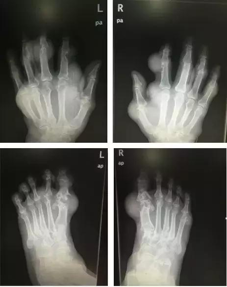 健康生活|看着就痛!36岁的他,双手双脚上都长满“石头”
