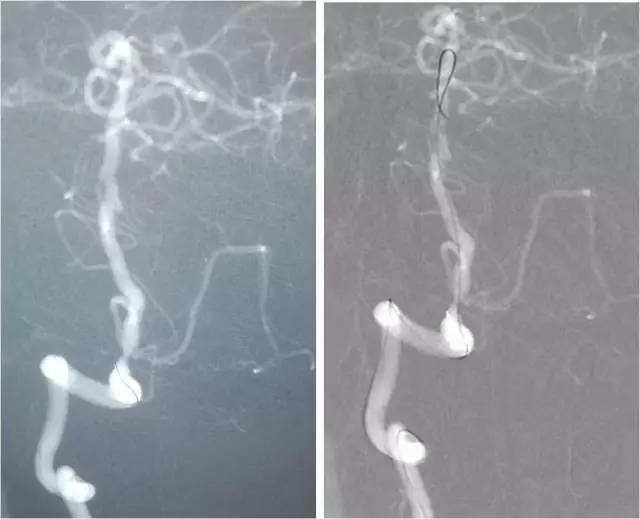 天坛周记,右侧椎动脉v4段较细小怎么治疗