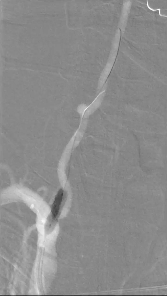 天坛周记,右侧椎动脉v4段较细小怎么治疗