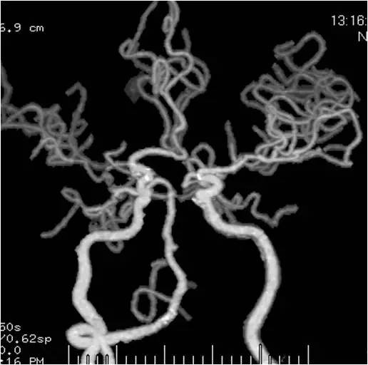 天坛周记,右侧椎动脉v4段较细小怎么治疗