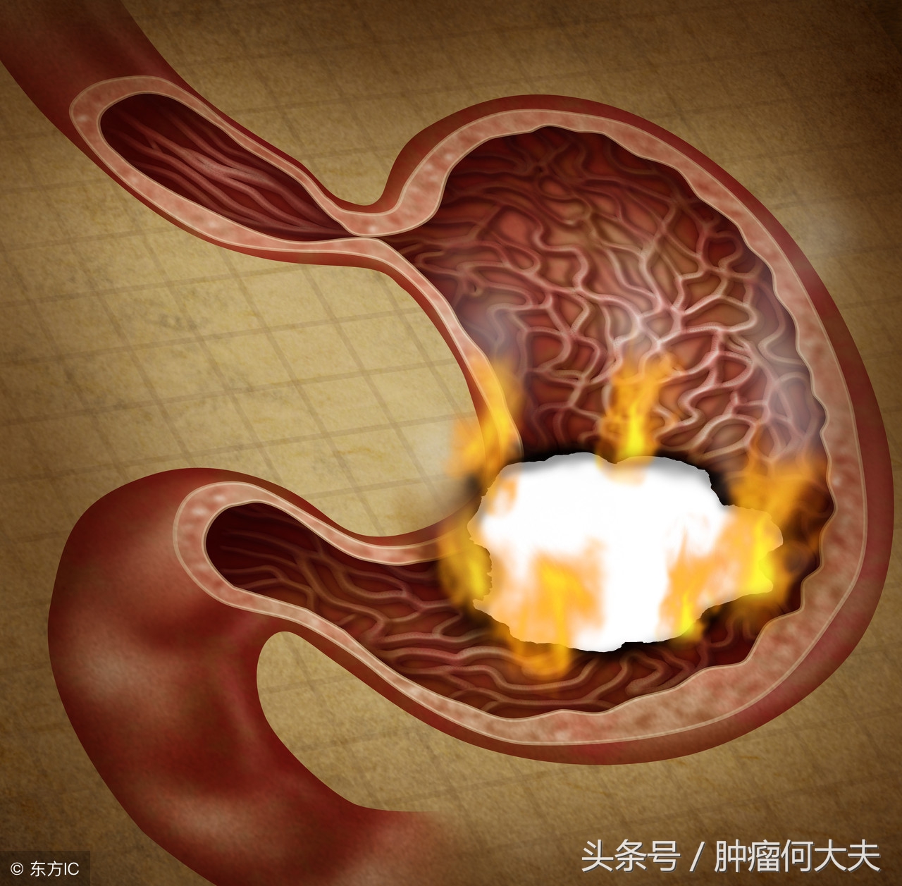 北京治疗胃癌最好的中医专家,胃癌低分化腺癌中医怎么治疗好