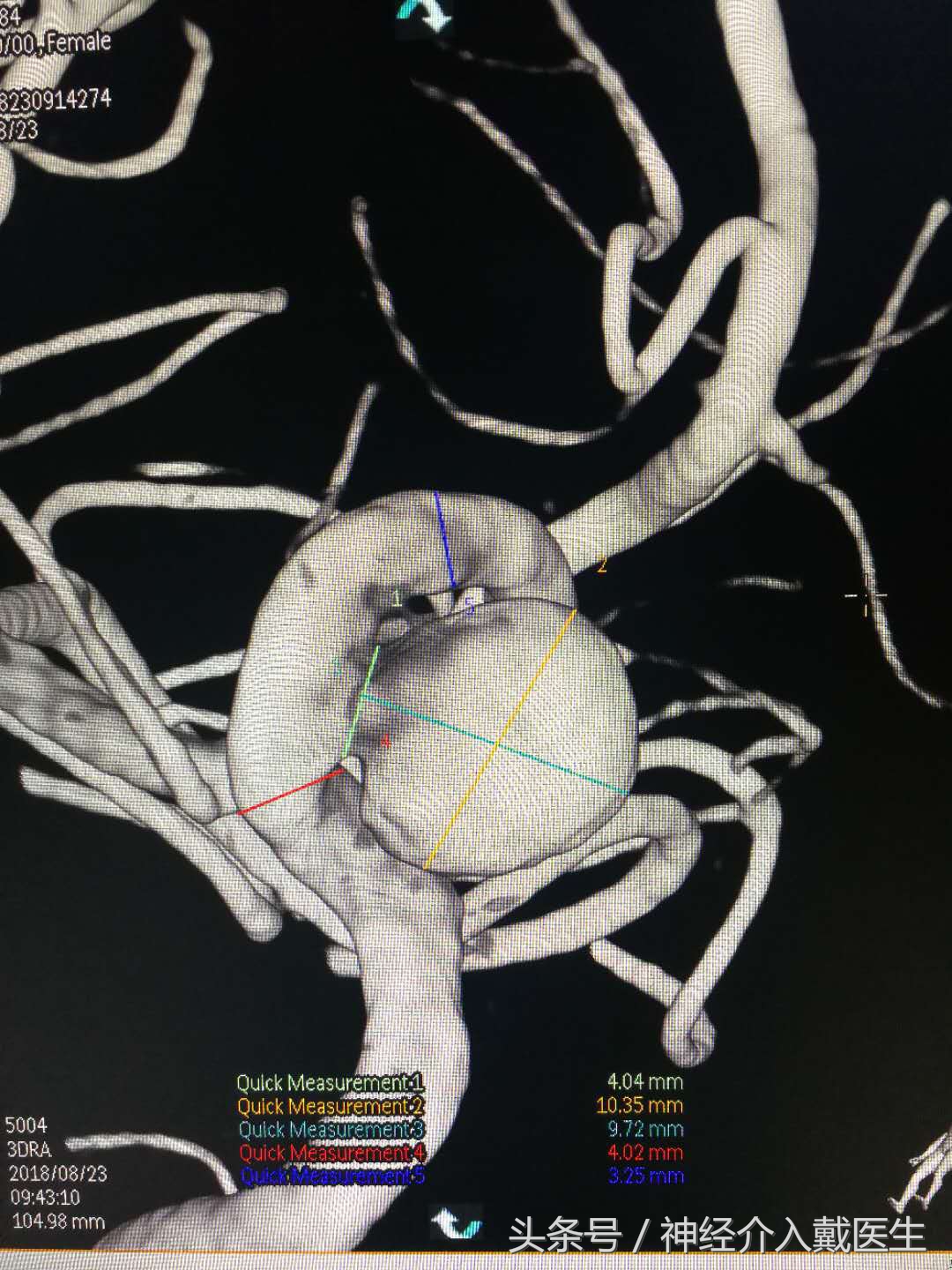 动脉瘤球囊辅助弹簧圈栓塞术,介入栓塞弹簧圈进口和国产区别