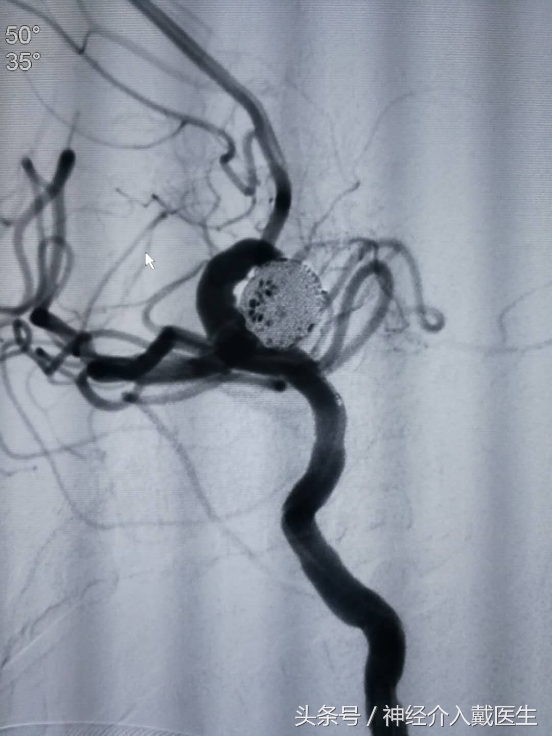 动脉瘤球囊辅助弹簧圈栓塞术,介入栓塞弹簧圈进口和国产区别