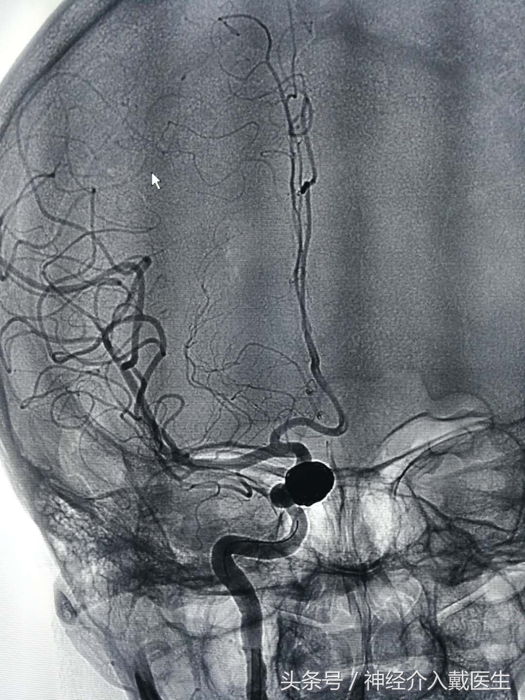 动脉瘤球囊辅助弹簧圈栓塞术,介入栓塞弹簧圈进口和国产区别