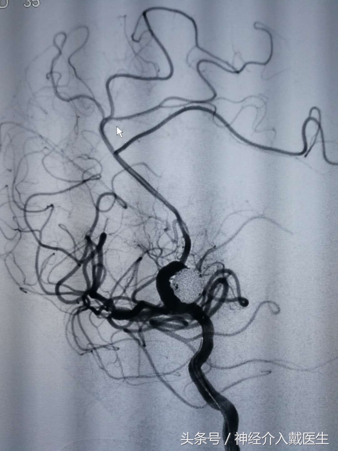 动脉瘤球囊辅助弹簧圈栓塞术,介入栓塞弹簧圈进口和国产区别