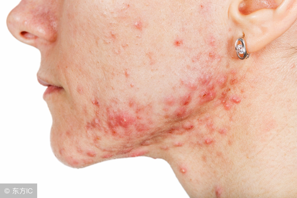 凉席螨虫咬人怎么去除,夏季凉席会造成螨虫过敏吗