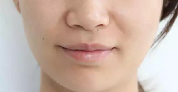 vc精华去法令纹,vc可以消除法令纹吗