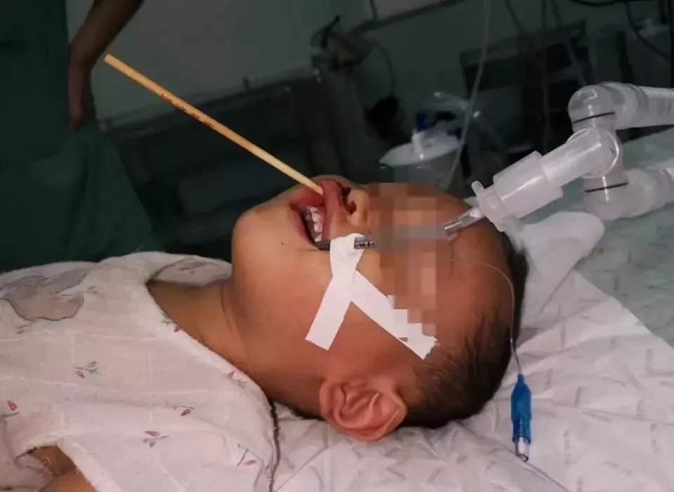 2岁孩子不小心把竹签穿喉咙,儿童用竹签戳到喉咙没有出血