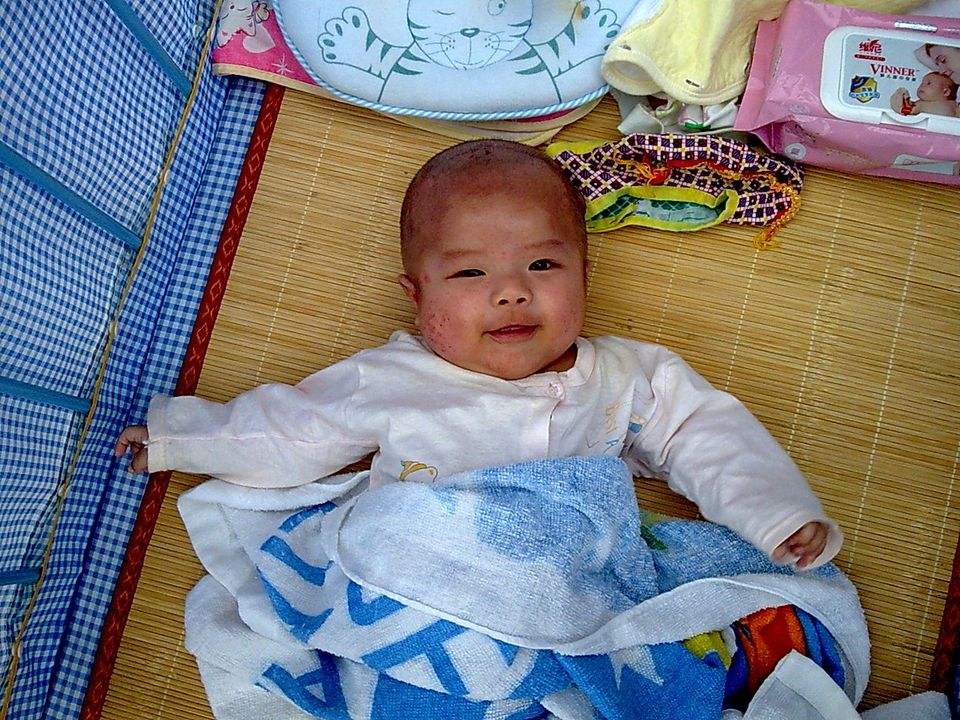 奶癣怎么快速消除小妙招,宝宝严重的奶癣怎么办