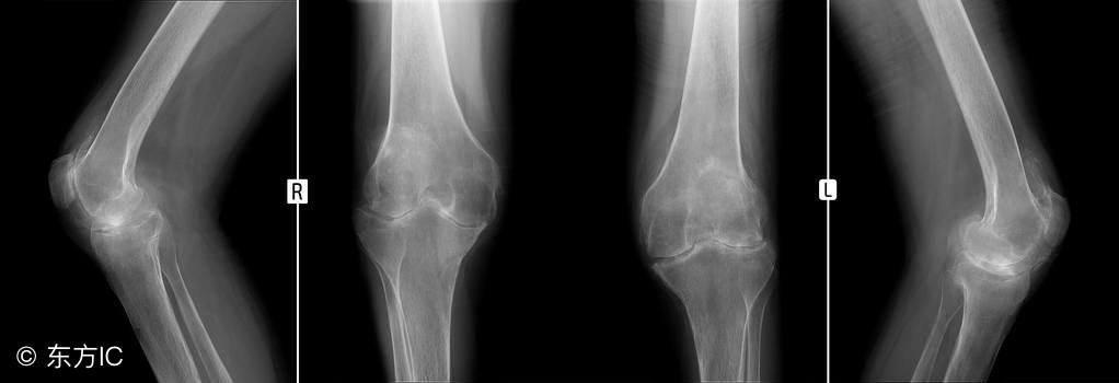 风湿性骨关节炎,骨关节炎与类风湿关节炎哪个严重