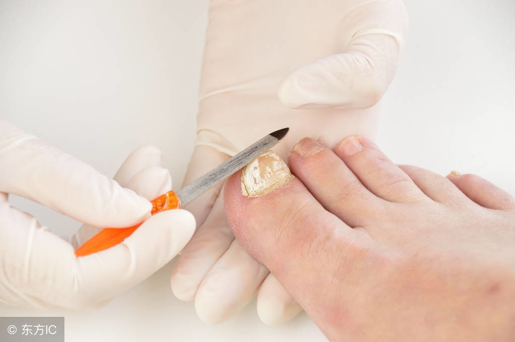 日本灰指甲水和中国灰指甲水对比,同仁堂灰指甲护理液治疗灰指甲吗