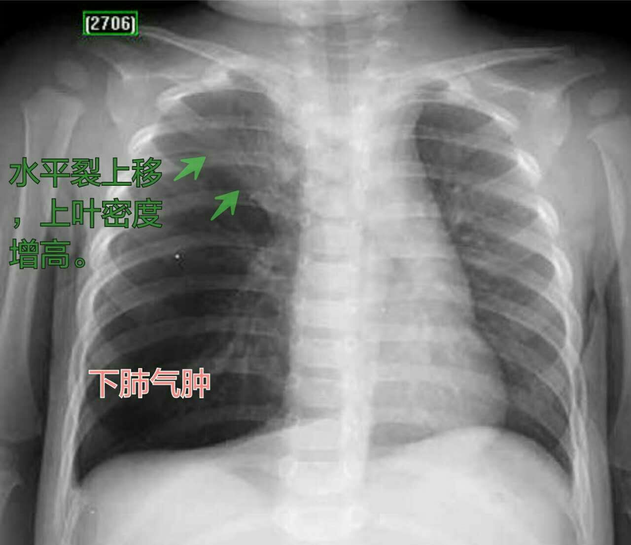 异物卡喉海姆立克急救法儿童,儿童异物卡喉咙海姆立克急救法