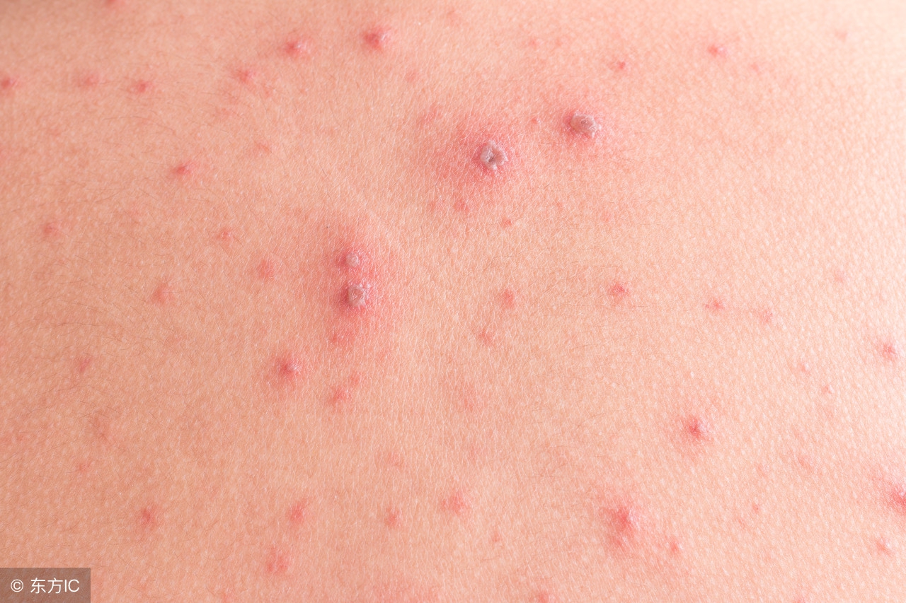 尖锐性湿疣治愈的标准是什么,彻底治愈尖锐性湿疣