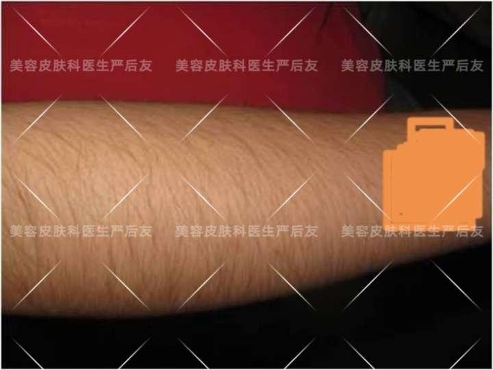 上海面部激光脱毛,日本全身激光脱毛