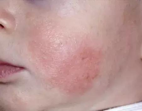 宝宝湿疹康复的全过程,宝宝湿疹不严重也不见好