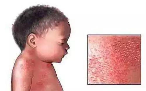 宝宝湿疹康复的全过程,宝宝湿疹不严重也不见好