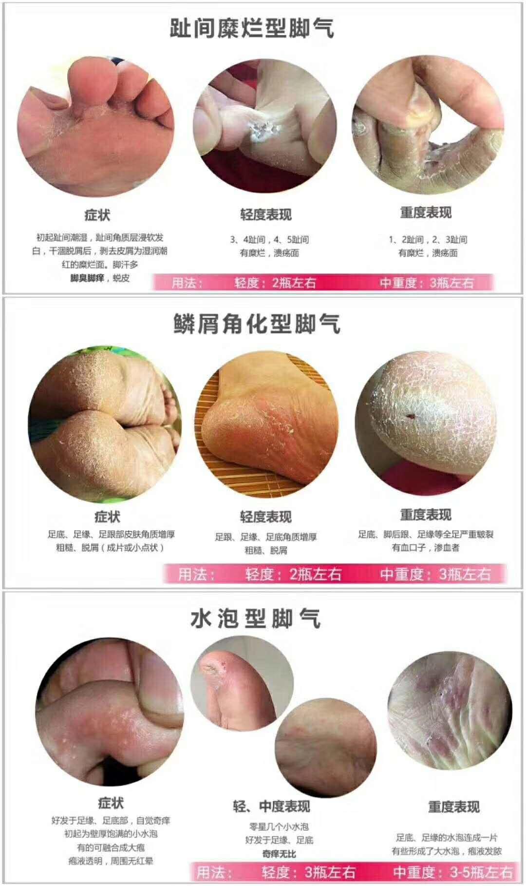 脚气治疗用什么药膏,脚气脚痒什么方法缓解最有效