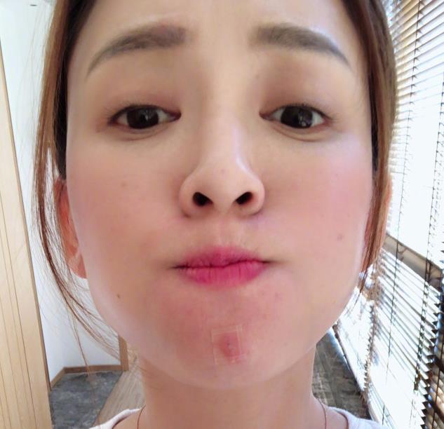 拯救痘痘肌攻略最新,拯救痘痘的方法