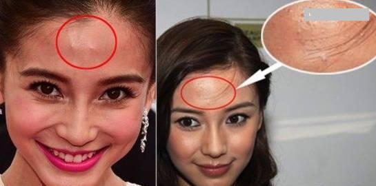 拯救痘痘肌攻略最新,拯救痘痘的方法